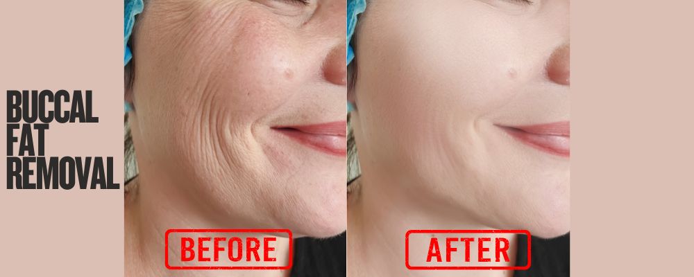Buccal fat removal before and after with buccal fat pad reduction, cost, remover options, and jawline results 10 years later.